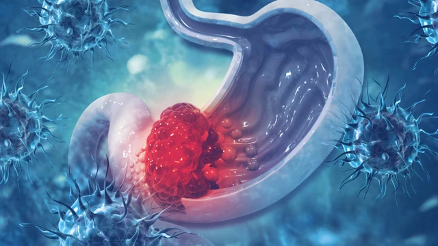 bai-viet/ung-thu-da-day-di-can-buong-trung-dau-hieu-tien-luong-va-dieu-tri.html