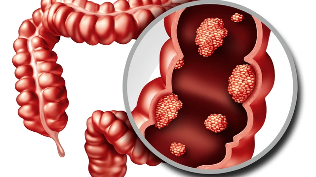 bai-viet/ung-thu-dai-trang-co-chua-duoc-khong.html