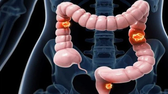 bai-viet/ung-thu-dai-truc-trang-co-chua-khoi-duoc-khong.html