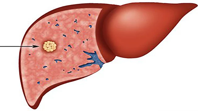 bai-viet/ung-thu-gan-co-chua-duoc-khong.html