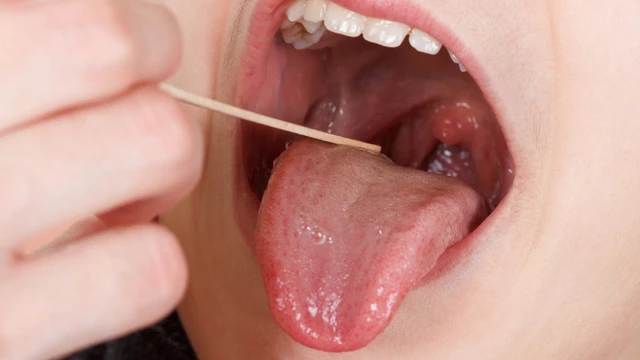 benh/ung-thu-khoang-mieng.html