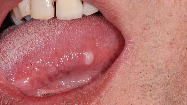 bai-viet/ung-thu-luoi-giai-doan-2-co-nguy-hiem-khong.html