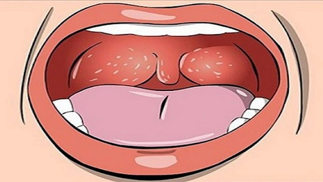 bai-viet/ung-thu-mieng-va-hau-hong-lua-chon-dieu-tri-56967.html