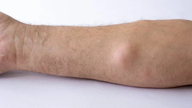 benh/ung-thu-mo-mo.html