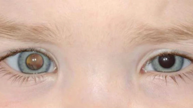 bai-viet/ung-thu-nguyen-bao-vong-mac-nguyen-nhan-trieu-chung-va-cach-dieu-tri-55914.html