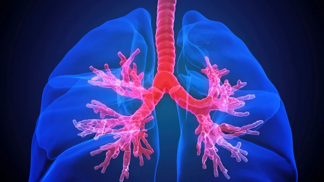 benh/ung-thu-phe-quan-425.html