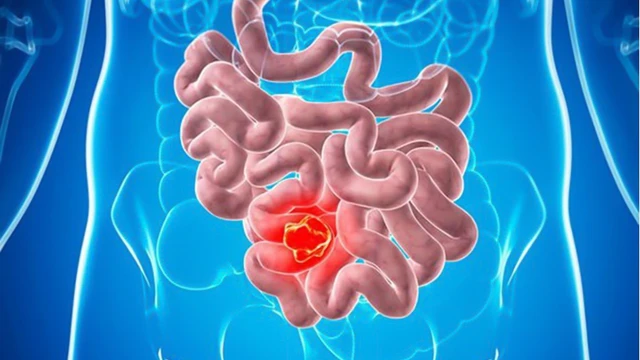 bai-viet/ung-thu-ruot-non-co-nguy-hiem-khong-dau-hieu-va-cach-dieu-tri.html