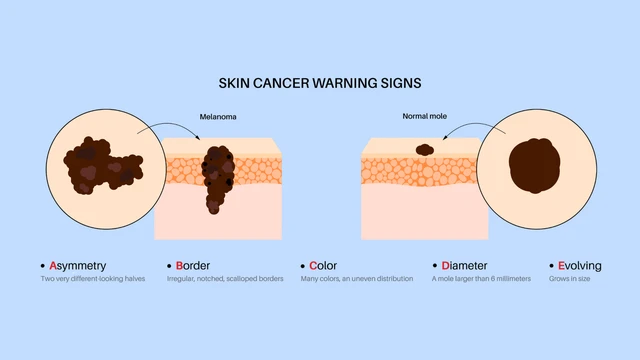 bai-viet/ung-thu-sac-to-la-gi-dau-hieu-muc-do-nguy-hiem-va-cach-dieu-tri.html