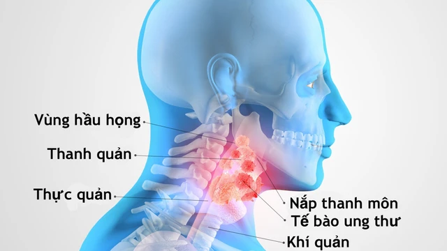 bai-viet/ung-thu-thanh-quan-giai-doan-cuoi-trieu-chung-cach-dieu-tri-va-cham-soc.html