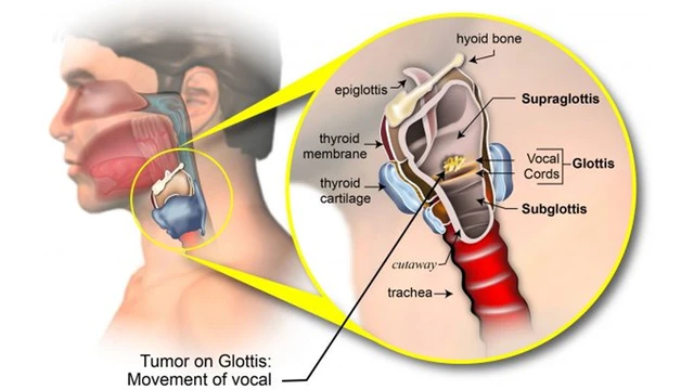 bai-viet/ung-thu-thanh-quan-nguyen-nhan-trieu-chung-chan-doan-va-dieu-tri-60919.html
