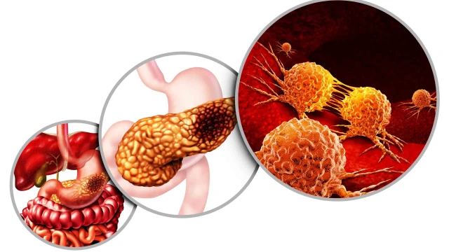 bai-viet/ung-thu-tuy-ngoai-tiet-yeu-to-nguy-co-va-cach-dieu-tri.html