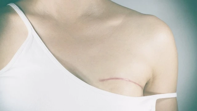 bai-viet/ung-thu-vu-the-tuy-la-gi-54573.html