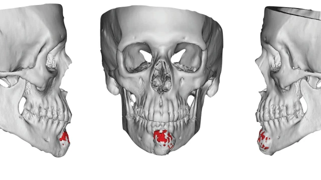 benh/ung-thu-xuong-ham.html