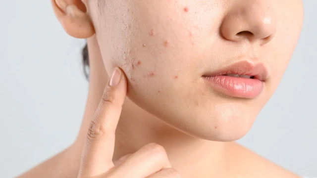 bai-viet/uong-bcaa-noi-mun-su-that-nguyen-nhan-va-cach-khac-phuc-an-toan-cho-lan-da.html