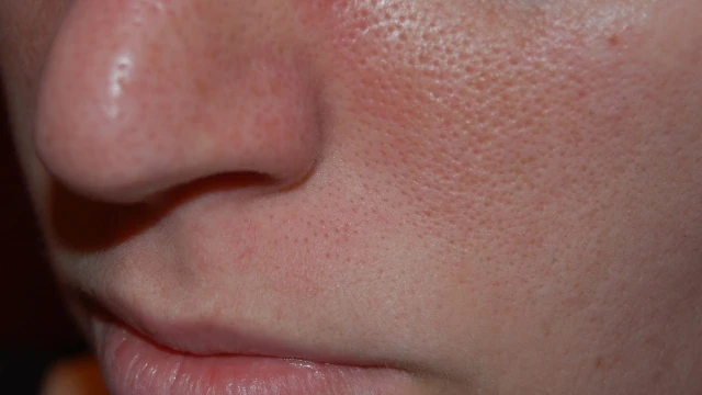 bai-viet/uong-dau-gac-bi-noi-mun-va-nhung-luu-y-khi-su-dung-dau-gac-an-toan-61917.html