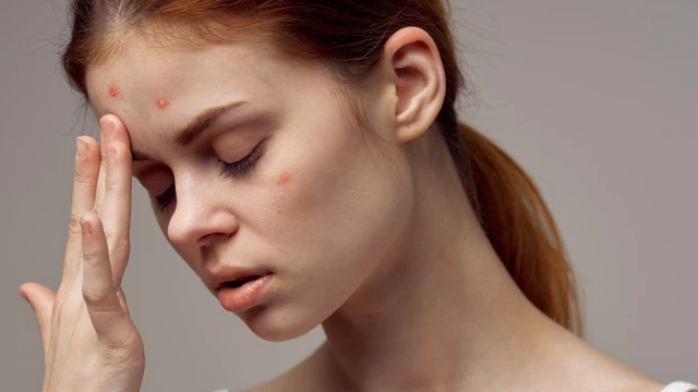 bai-viet/vi-sao-uong-tinh-dau-hoa-anh-thao-bi-noi-mun.html