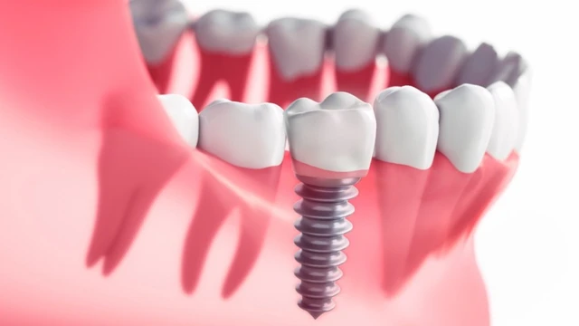 bai-viet/uu-va-nhuoc-diem-khi-thuc-hien-cay-ghep-implant-tuc-thi.html