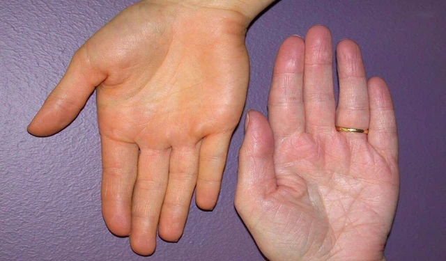 benh/sot-vang-156.html
