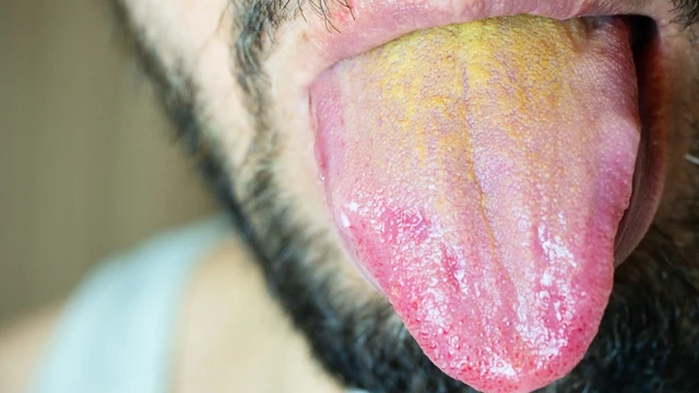 bai-viet/vang-luoi-bieu-hien-cua-benh-gi-lam-the-nao-khi-bi-vang-luoi.html