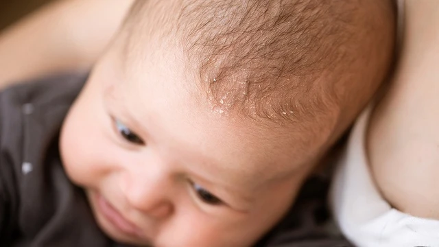 bai-viet/vay-nen-da-dau-la-gi-nguyen-nhan-gay-vay-nen-da-dau-o-tre-em.html