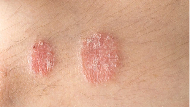 bai-viet/vay-nen-dong-tien-nguyen-nhan-va-cach-dieu-tri-hieu-qua.html