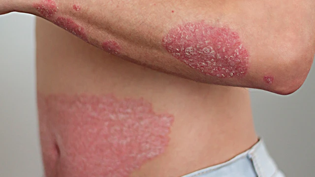 bai-viet/vay-nen-giai-doan-dau-co-trieu-chung-gi-cach-dieu-tri-nhu-the-nao.html