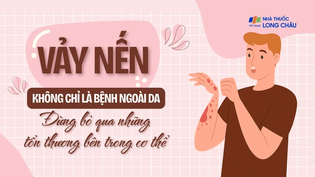 bai-viet/vay-nen-khong-chi-la-benh-ngoai-da-dung-bo-qua-nhung-ton-thuong-ben-trong-co-the.html