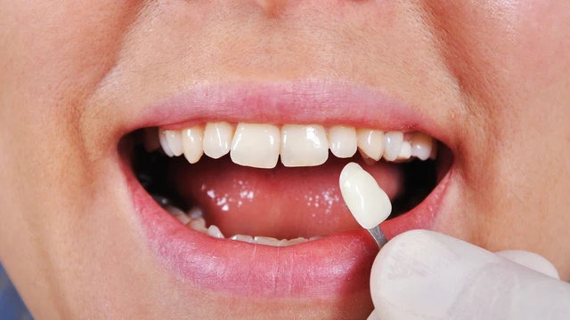 bai-viet/veneers-la-gi-phuong-phap-dan-veneers-co-uu-nhuoc-diem-gi.html