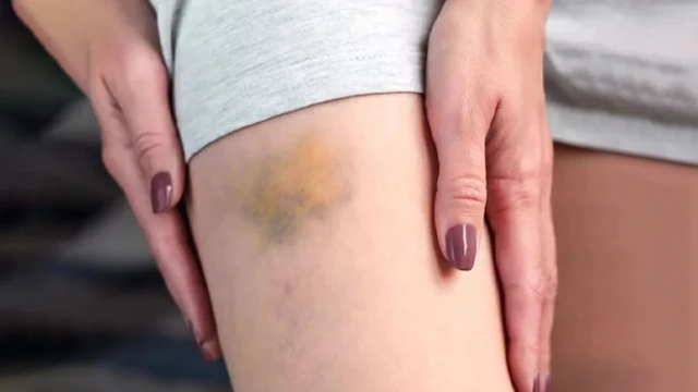 bai-viet/vet-bam-tim-bao-lau-thi-het-nguyen-nhan-va-cach-xu-ly.html