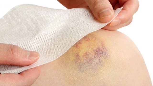 bai-viet/vet-bam-la-gi-nguyen-nhan-gay-bam-tim-va-cach-xu-ly.html