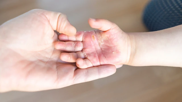 bai-viet/vet-bong-bi-phong-nuoc-phai-lam-sao.html