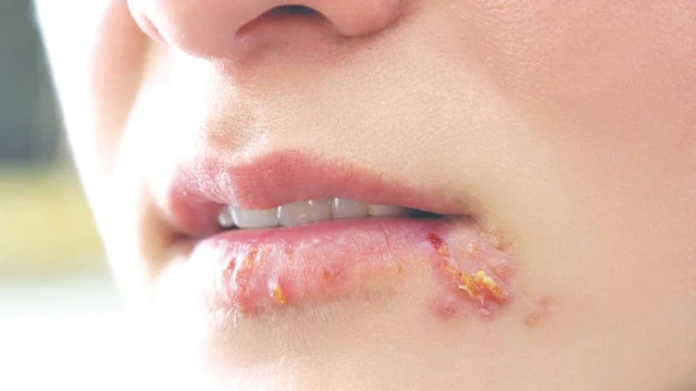 bai-viet/vet-loet-lanh-la-gi-vet-loet-lanh-co-trieu-chung-nhu-the-nao.html