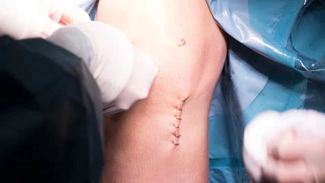 bai-viet/vet-mo-bi-sung-cung-ben-trong-la-gi-co-nguy-hiem-khong.html