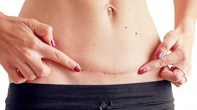 bai-viet/vet-mo-sau-sinh-bao-lau-thi-lanh-cach-cham-soc-sau-sinh.html