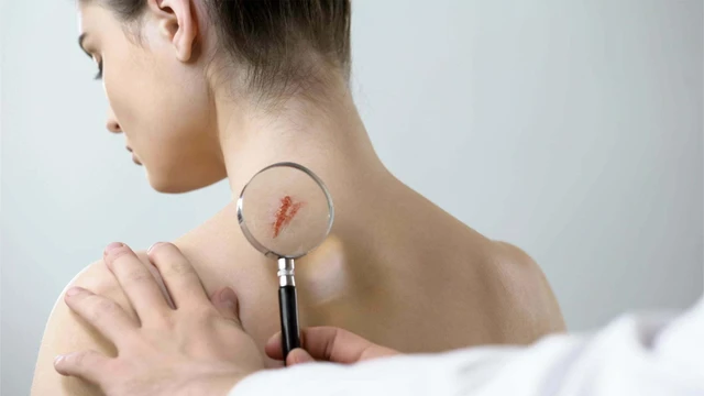 bai-viet/cach-khac-phuc-vet-seo-va-han-che-de-lai-seo-hieu-qua-khi-bi-vet-thuong.html