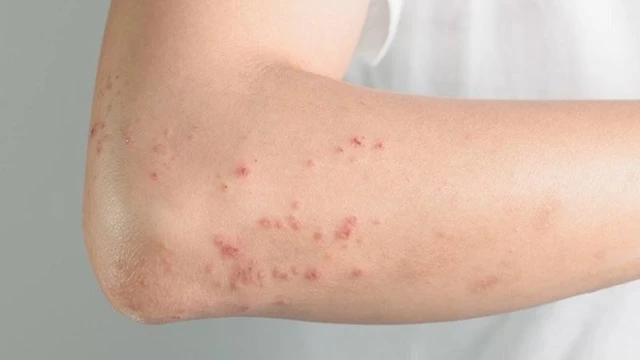 bai-viet/vi-sao-bi-ghe-mai-khong-khoi-va-lam-the-nao-de-tri-dut-diem.html