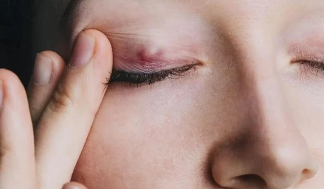 bai-viet/vi-sao-nhan-mi-bi-noi-cuc-co-khac-phuc-duoc-khong-va-cach-phong-ngua-66306.html