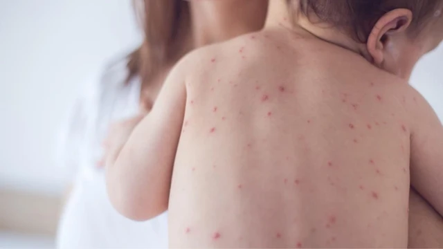 bai-viet/vi-sao-soi-va-sot-phat-ban-thuong-de-nham-lan-cach-phan-biet-soi-va-sot-phat-ban.html