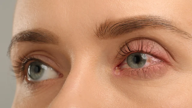 bai-viet/viem-bo-mi-duoi-la-gi-dau-hieu-nhan-biet-va-cach-dieu-tri-hieu-qua.html