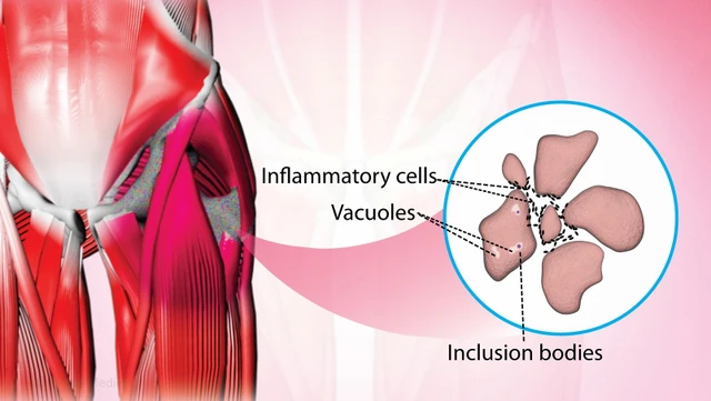 bai-viet/viem-co-the-vui-nguyen-nhan-trieu-chung-chan-doan-va-phuong-phap-dieu-tri.html