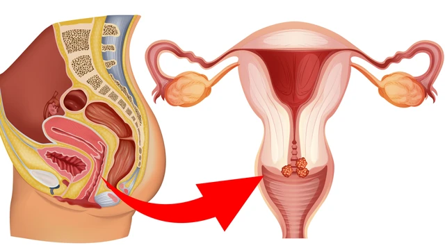 bai-viet/viem-co-tu-cung-dat-thuoc-bao-lau-thi-khoi.html