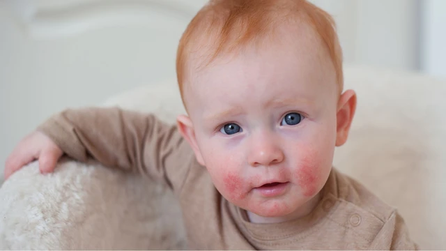 Viêm da cơ địa có chữa được không? Biện pháp điều trị và phòng ngừa