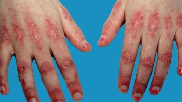 bai-viet/viem-da-co-va-viem-da-co-la-gi.html