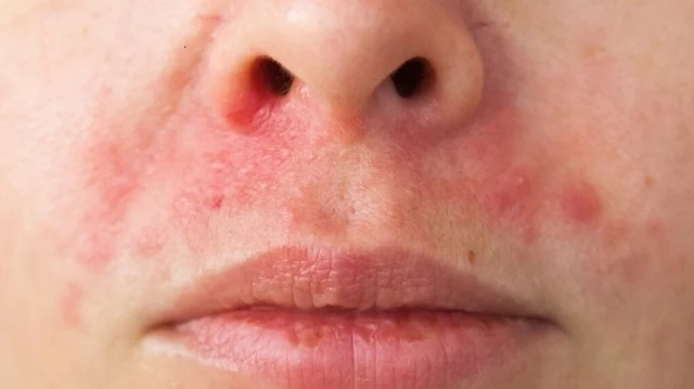 bai-viet/viem-da-dau-canh-mui-nguyen-nhan-trieu-chung-va-cach-khac-phuc.html