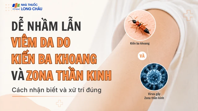 Viêm da do kiến ba khoang dễ nhầm với Zona: Cách nhận biết và xử trí đúng 
