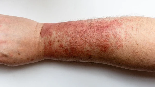 bai-viet/viem-da-tiep-xuc-anh-sang-la-gi-nguyen-nhan-trieu-chung-cach-dieu-tri.html