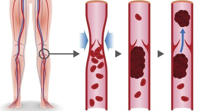 Viêm đa vi mạch là gì? Những vấn đề cần biết về bệnh viêm đa vi mạch 2