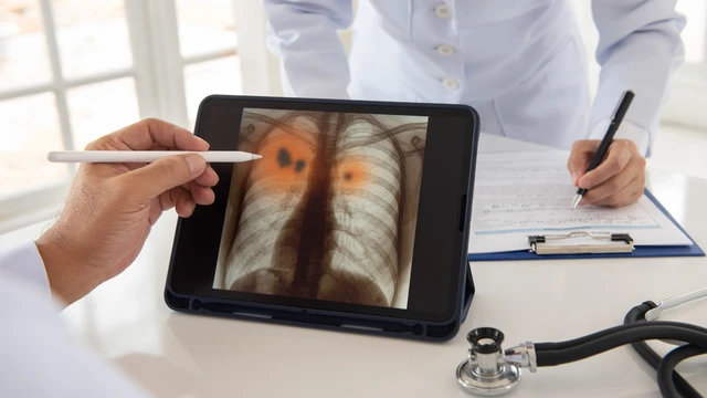 Viêm đường hô hấp dưới