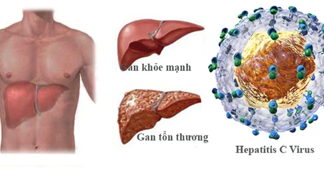 bai-viet/viem-gan-c-co-tu-khoi-khong-hieu-ro-ve-benh-va-cac-phuong-phap-dieu-tri.html