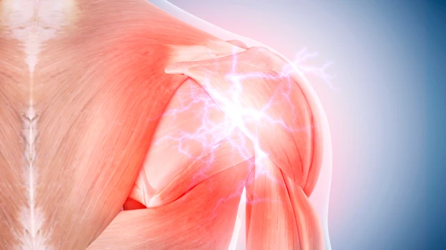 Viêm gân vôi hóa: Nguyên nhân, triệu chứng và cách điều trị